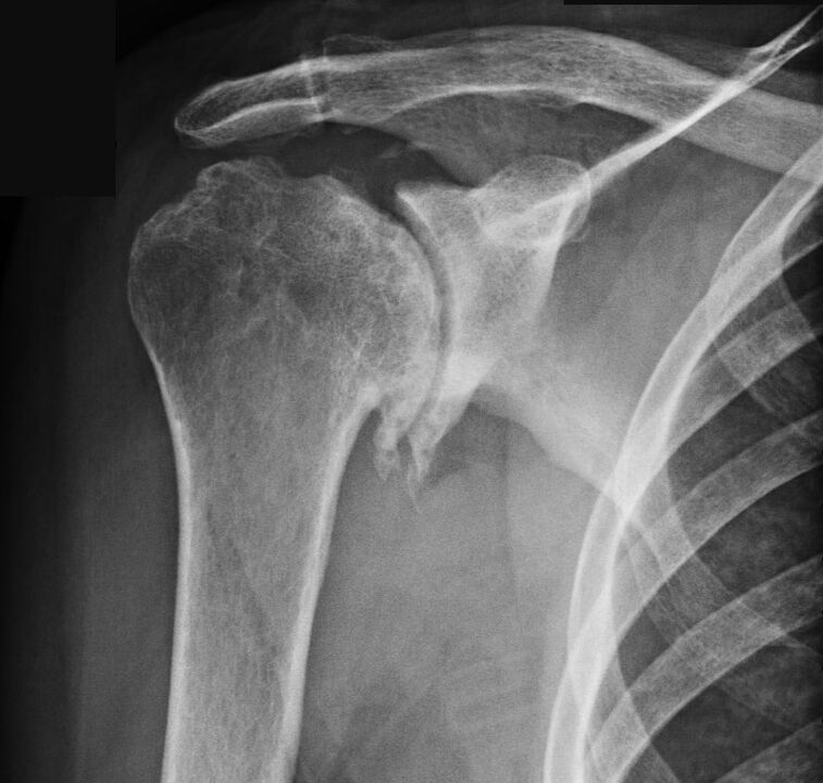 The x-ray showed osteoarthritis of the shoulder. 