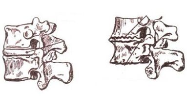Stages of Cervical Osteochondrosis Development