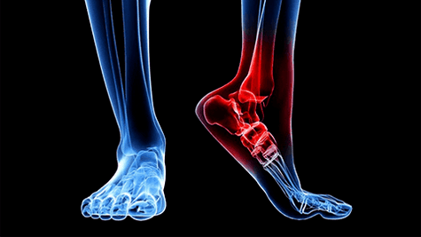 Ankle joint osteoarthritis