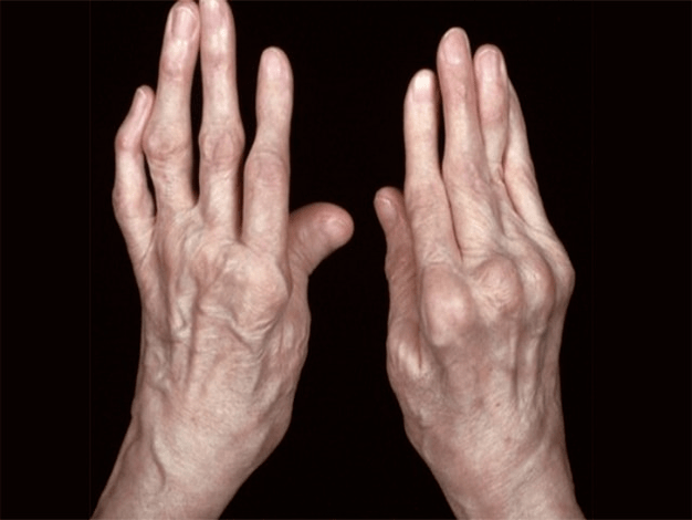 Arthritis as a cause of fingertips in the fingertips