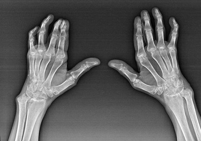 Diagnosis of fingertips