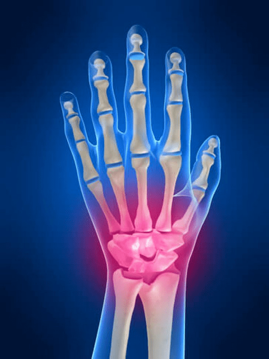 Joint arthritis