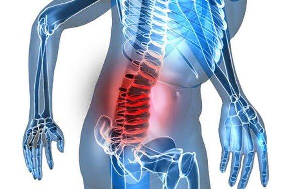 Deformity of the spine in the fourth stage of lumbar osteochondrosis.