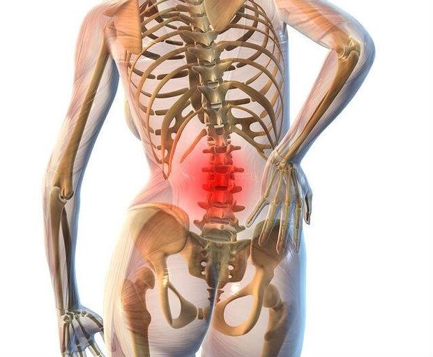 Osteochondrosis of the lumbar spine.