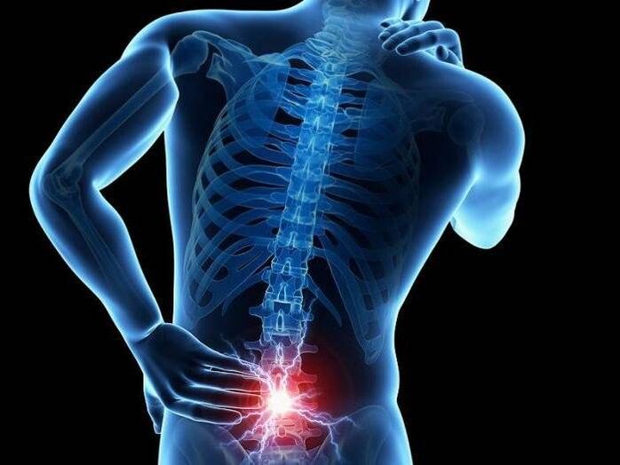 With radiculitis, pinched nerve roots cause sharp pain in the lower back.