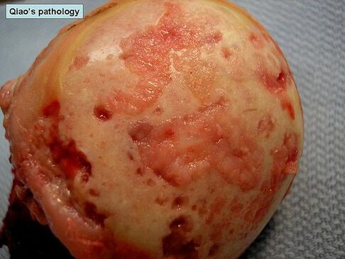 Cartilage surface affected by osteoarthritis.