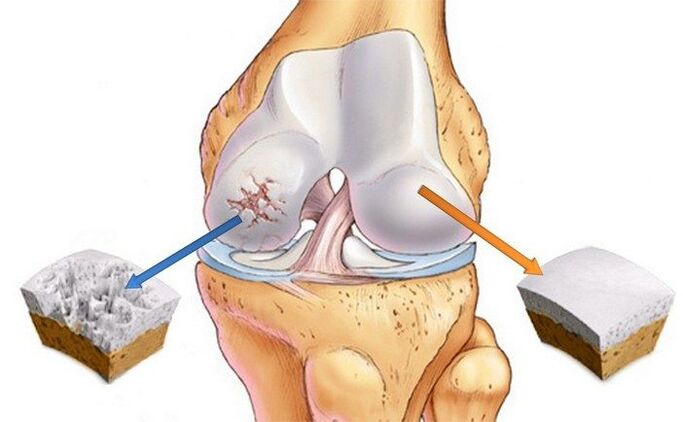 Healthy and arthritic joints.