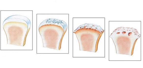 Healthy joint and 3 degrees of osteoarthritis development.
