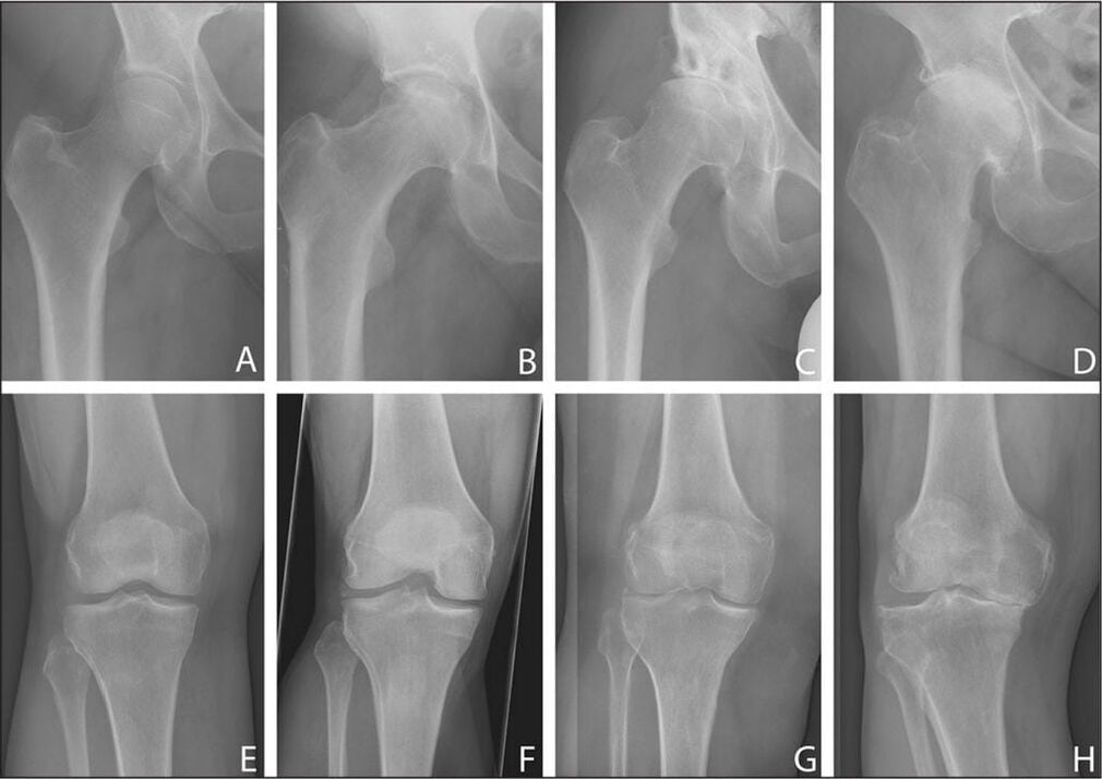 Stages of development of joint osteoarthritis on an x-ray.