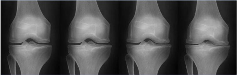 Stages of osteoarthritis according to the Kellgren-Lawrence classification