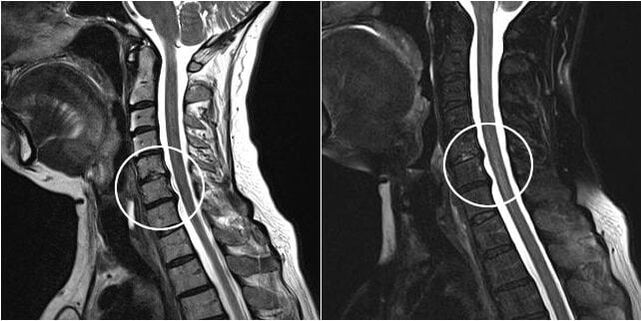 MRI of the cervical spine with signs of osteochondrosis.